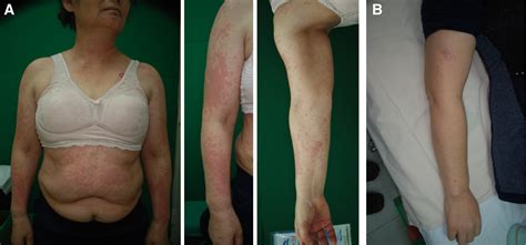 A Randomized Controlled Trial Of Epidermal Growth Factor Ointment For