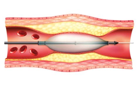 Dallas Angioplasty And Stent Placement Peripheral Angioplasty