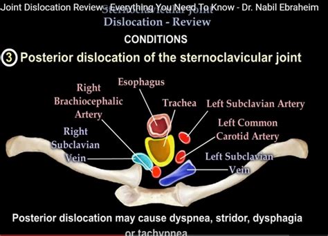 Sternoclavicular Dislocation —