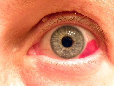 Painless Red Eye Aafp