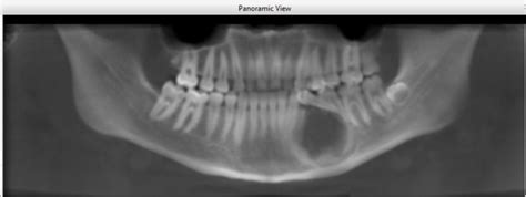 Cysts Of The Jaw Dr Khaled Amin Tarboush Dds Ms Cags