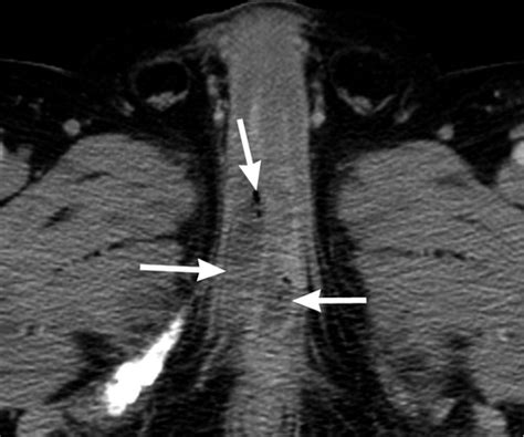 Early ct findings of fournier's gangrene in a healthy male. Fournier Gangrene: Role of Imaging | RadioGraphics