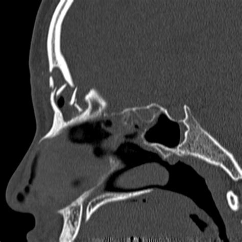 Frontal Sinus Fracture Image
