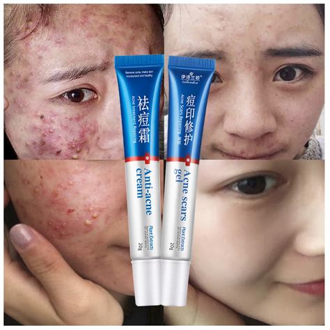 ISILANDON Soins Du Visage Clair De Traitement De L'acné Crème