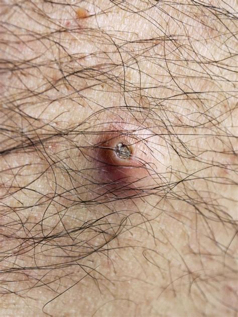 Sebaceous Cyst Removal Infections And Treatment