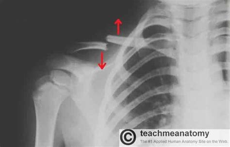 The Clavicle Functions Landmarks Fractures Teachmeanatomy