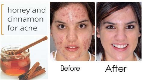 Honey And Cinnamon Mask For Acne How To Remove Pimples From Face