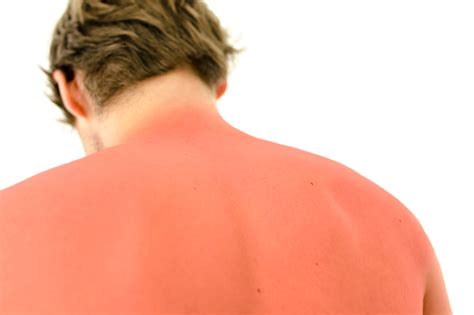 Sun Poisoning Symptoms And Treatment Upmc Healthbeat