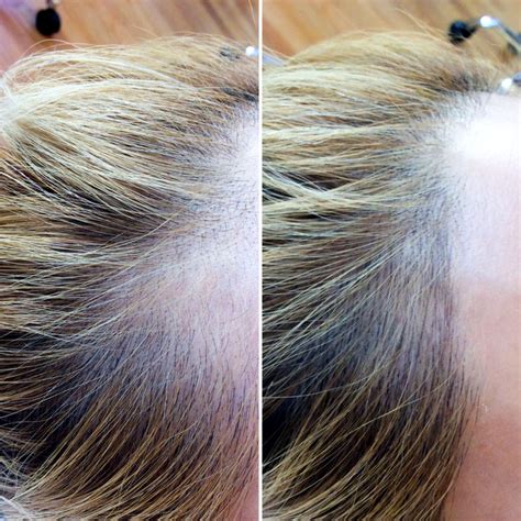 Thinning hair is a concern for women and men alike, but it's important to understand the different types and causes in order to promote stronger, healthier hair. Shedding? Top Tricks To Ease Thinning Hair Struggles ...