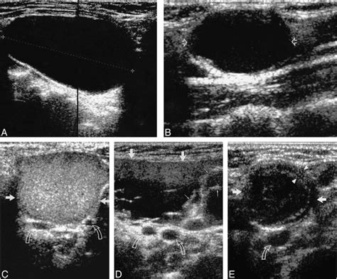 Second Branchial Cleft Cysts Variability Of Sonographic Appearances In