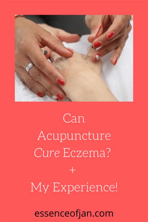 Can Acupuncture Cure Eczema Plus My Experience Essence Of Jan