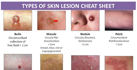 Types Of Skin Lesions Skin Lesion Removal Electrolysis Hair Removal