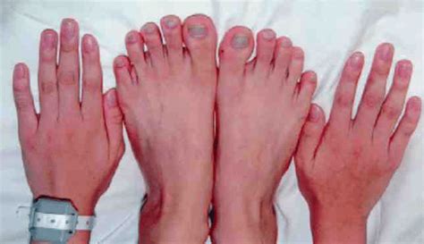 Appearance Of The Fingernails And Toenails Of The Patient Who Presents
