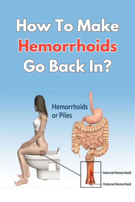 Hemorrhoids Are Linked To Persistent Constipation Exerting Pressure