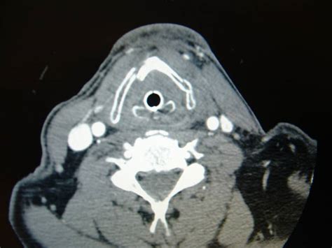 Laryngeal Fracture * Otolaryngology Houston