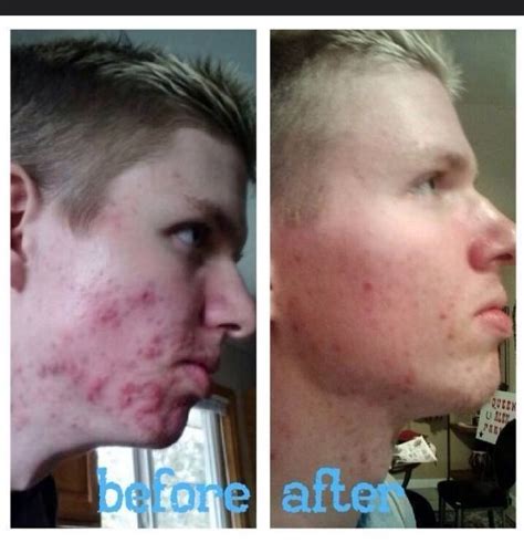What Young Man Wouldnt Love To These Kinds Of Results With His Acne