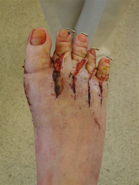 How to know if stitches are infected? Gwen's Feet (and Hand): Having Fifty-Five Stitches Out Hurts!