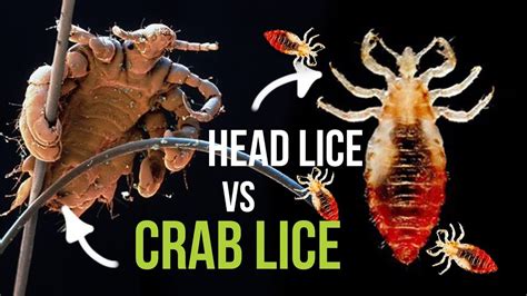 Crab Lice Vs Head Lice What Is The Difference Youtube