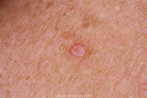 Bcc Basal Cell Carcinoma