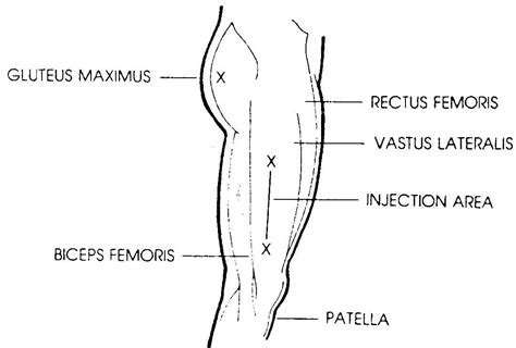 Find the middle of the thigh: Administer Intramuscular, Subcutaneous, and Intradermal ...