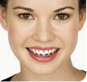 Does health or dental insurance cover braces? » Dental Braces Cost in the Philippines
