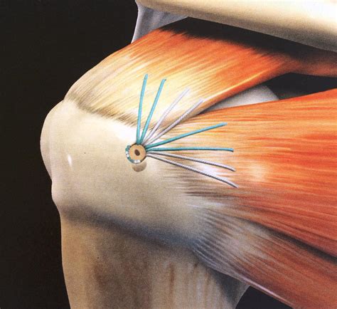 Please note that certain bio (plla) anchors and screws are not. Shoulder Surgery and Replacement