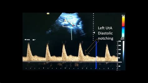 Uterine Artery Doppler Youtube