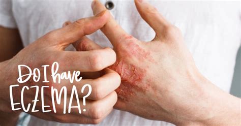 Do I Have Eczema Learnderm Inverness Dermatology And Laser