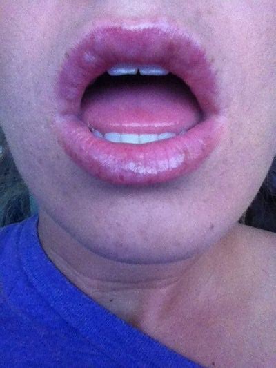 Small White Bumps On Lips Herpes Blisters