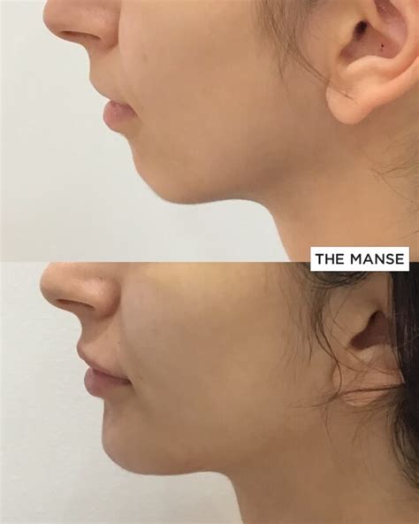 Chin Fillers Before And After