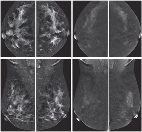 Contrast Enhanced Spectral Mammography Cesm Indications