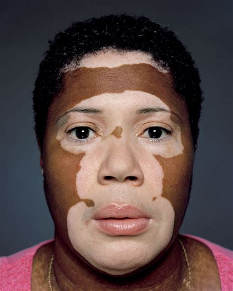 Any location on the body can be affected, and most people with vitiligo have white patches on many areas. Arthritis Drug Could Be Used for Treating Vitiligo, Study ...