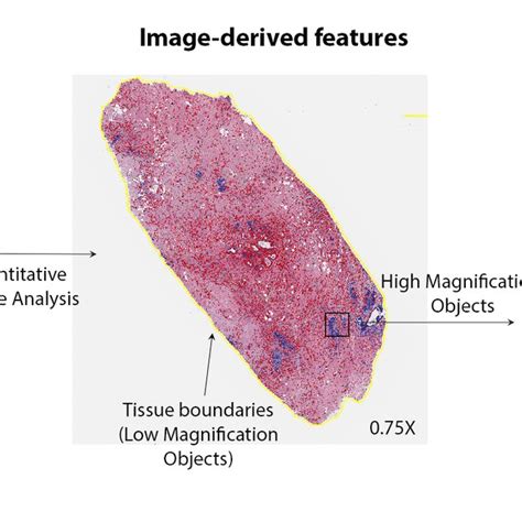 Histological Grade Of Breast Cancer Assessed By The Nottingham Download Scientific Diagram