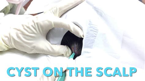 Cyst On The Scalp At Coastal Dermatology And Medspa Youtube