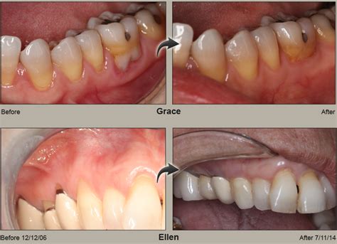 Pinhole Surgical Technique Vancouver Burnaby Gum Recession Treatment