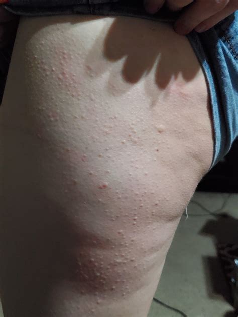 Wife Is Getting Strange Bumps Primarily Over Backarmslegs For About