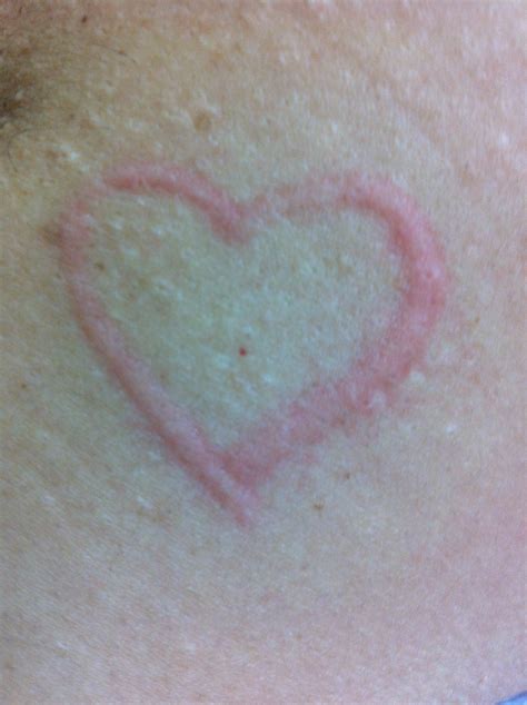 Hives Rash Treatment In Florida Hives Skin Allergy