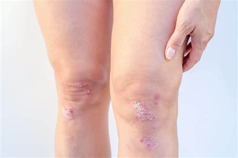 Tips And Tricks To Cope With Psoriasis Skin And Cancer Institute