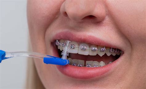Signs Of Tooth Decay With Braces What You Need To Know Elara