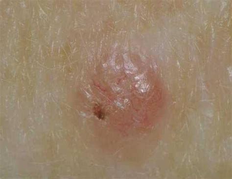 How Does Skin Cancer Start