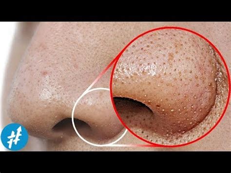 Maybe you would like to learn more about one of these? VIDEO Cara Menghilangkan Jerawat Hitam Di Hidung Terbaru