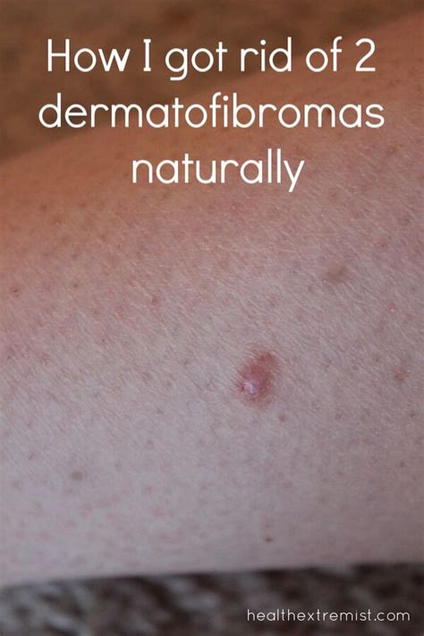 How To Get Rid Of A Dermatofibroma Naturally