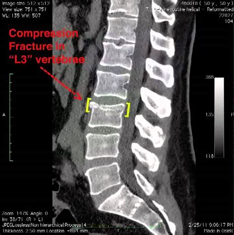 L3 Spinal Compression Fracturemov Youtube