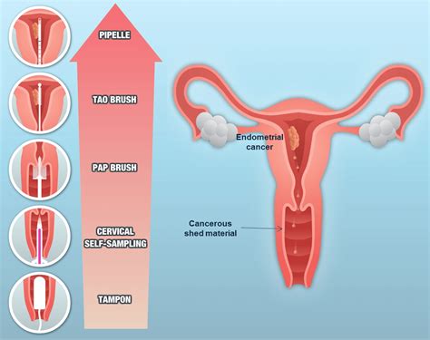 Aproape toate cazurile de cancer oral sunt caracterizate prin dezvoltarea de celule scuamoase, plate, care acoperă suprafeţele. Análisis moleculares para mejorar la detección y ...
