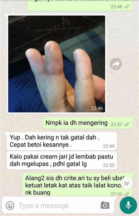 Ubat farmasi untuk sakit pinggang. Ubat Gatal Biji Air - Contoh Ond