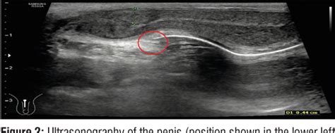 Figure 2 From Role Of Penile Doppler As A Diagnostic Tool In Penile