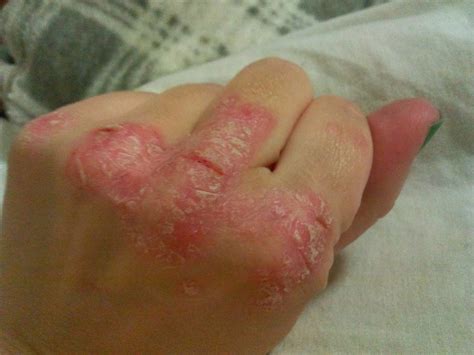 Sausage Toes And Scales Living Life With Psoriatic Arthritis Cimzia