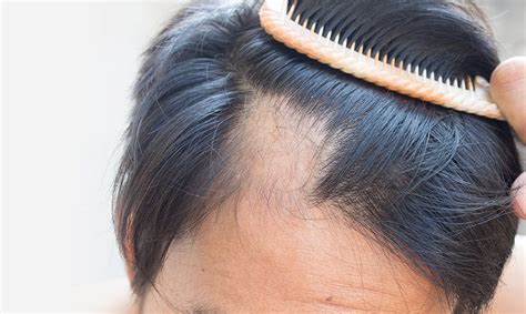 Los 4 Tipos De Alopecia Causas Y Posibles Tratamientos