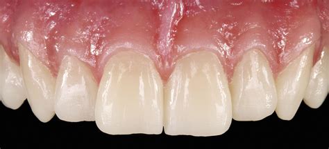 Resin Dental Material For Dental Restorations Multi Color
