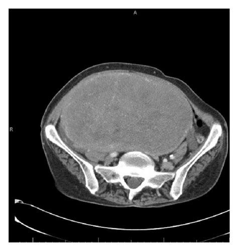 Uterine Fibroids Benign Tumor Of The Uterus Leimyoma